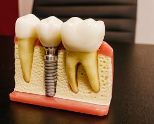 Guide to dental implants in Midland, TX.